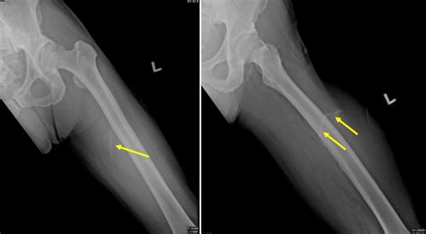 Extraskeletal osteosarcoma – Radiology Cases