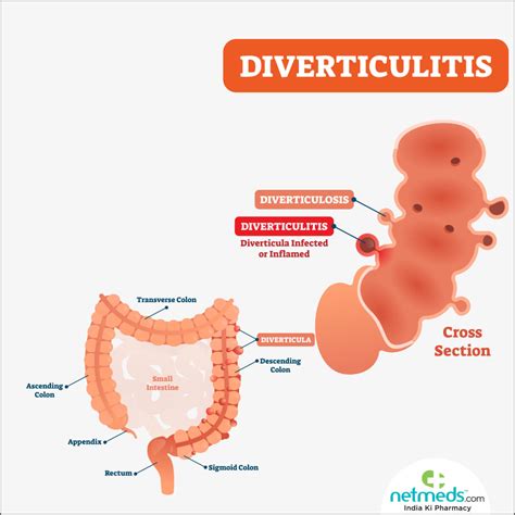 Diverticulitis – Causes, Symptoms and Treatment | Netmeds