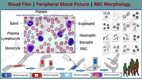 Peripheral Blood Smear Test Purpose, Procedure, Results and more | Lab ...