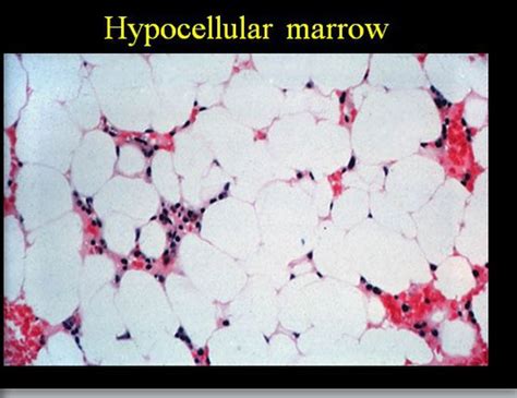 hypoproliferative anemias and intro to hemolytic anemia Flashcards ...