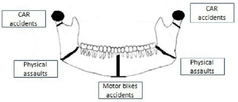 Etiologic classification of mandibular fracture. | Download Scientific ...