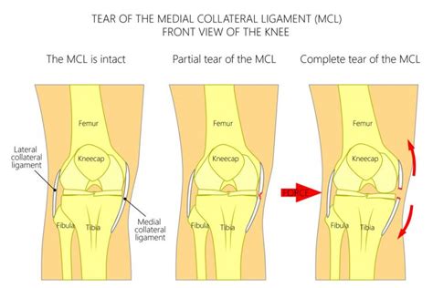 Exercises To Avoid With Mcl Injury - Exercise Poster