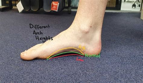 Flat feet vs arched feet - Know the differences & How to treat them