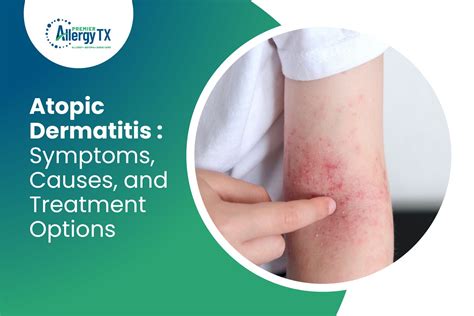 Symptoms, Causes, and Treatment Options for Atopic Dermatitis