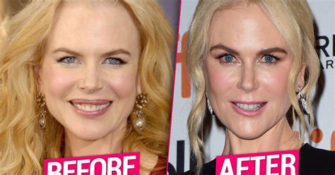 Nicole Kidman’s Plastic Surgery Transformation -- Top Docs Claim ...