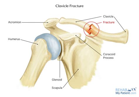 Proximal Clavicle Fracture