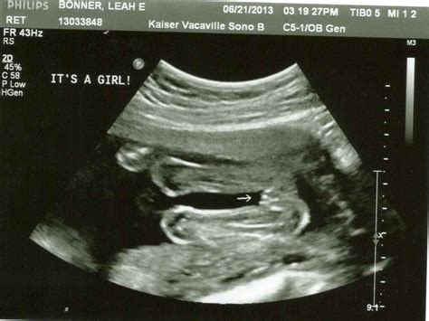 Short bus to minivan: Baby Girl, 20 Week Ultrasound