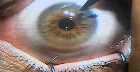 YAG Laser Eye Surgery after Cataract Surgery – EYExan.com