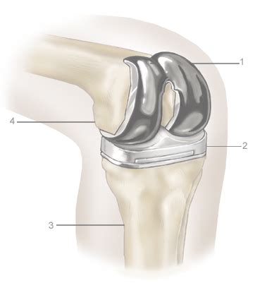 Knee Replacement Cost - Price With and Without Insurance