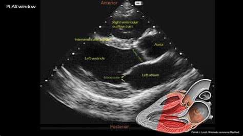 Introduction to Focused Cardiac Ultrasound: The Parasternal Long Axis ...