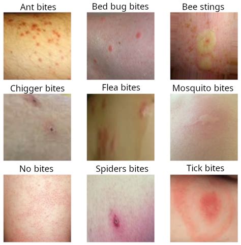 Identifying Bug Bites How To Prevent Treat Identifying Bug Bites ...