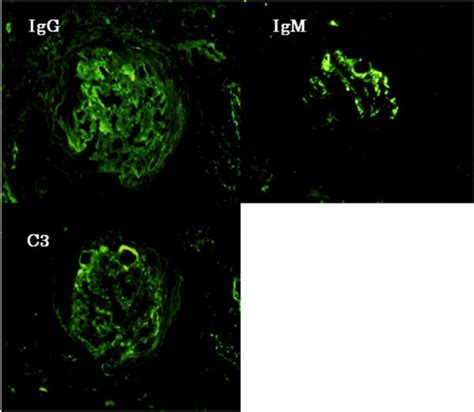 Immunofluorescence microscopy findings. Immunofluorescent studies ...