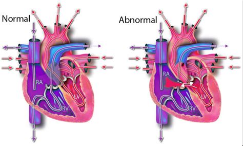 Atrial Septal Defect Surgery in India - Updated 2024