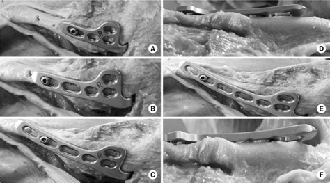 (A) A 4-hole clavicular hook plate was applied and all holes were in ...