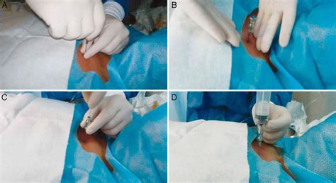 Bone Marrow Biopsy - Reasons, Pain, Complications