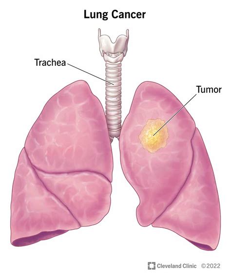 Understanding Lung Cancer - Ask The Nurse Expert