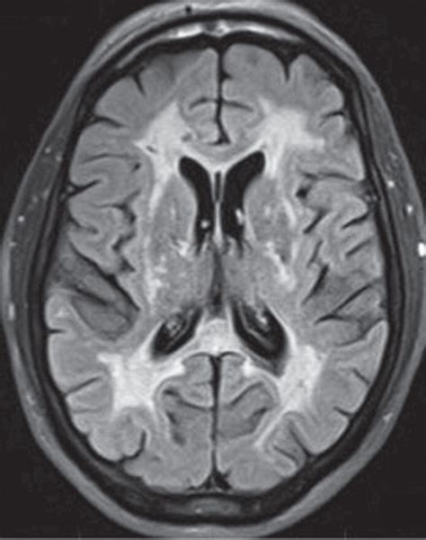 White Matter Diseases with Radiologic-Pathologic Correlation ...