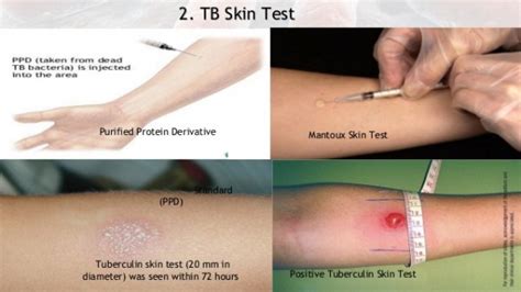 How do we test for whether a person has Tuberculosis or not? - Canada's ...