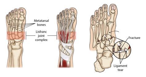 Lisfranc (Midfoot) Injury - OrthoInfo - AAOS