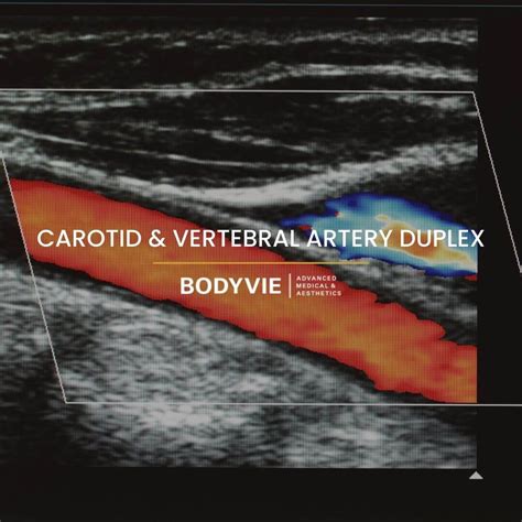 Vertebral Carotid Duplex Scan