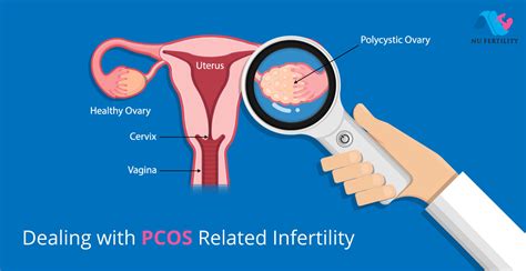 How to get pregnant with pcos quickly? | Infertility Clinic Bangalore