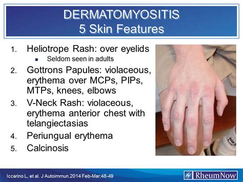 Dermatomyositis: 5 Skin Features | RheumNow