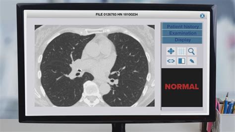 Doctors say lung scans show devastating impacts from COVID | wtsp.com