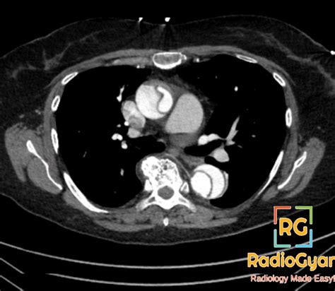 Aortic Dissection | Radiology Reference Article - RadioGyan