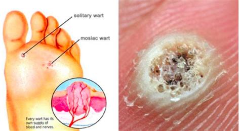 Plantar Wart - The Podiatry Experts