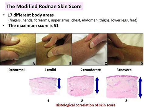 Diagnosis and Early Management of Scleroderma - YouTube