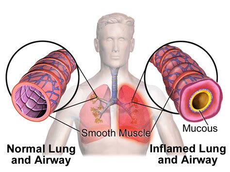 Bronchoconstriction - Wikipedia