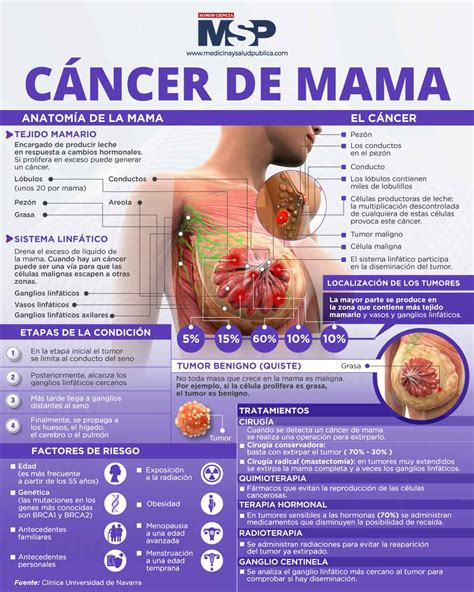 Cáncer de seno - Infografía