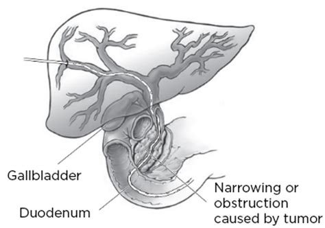 About Your Biliary Drainage Catheter | Memorial Sloan Kettering Cancer ...