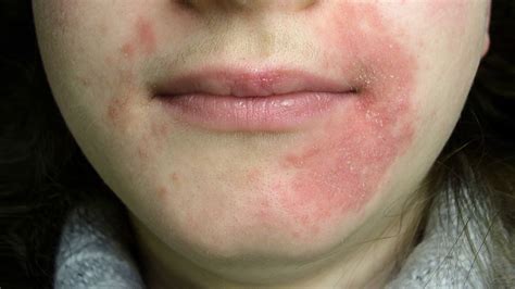 What Is Perioral Dermatitis? Symptoms, Causes, Diagnosis, Treatment ...