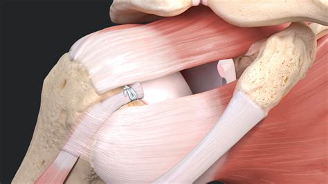 Arthrex - Loop 'N' Tack™ Biceps Tenodesis