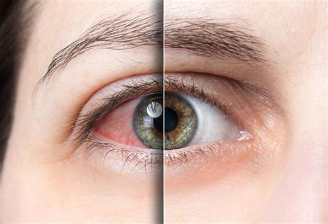 5 Serious Causes of Red Eyes: Luis C Omphroy, M.D.: Ophthalmology ...