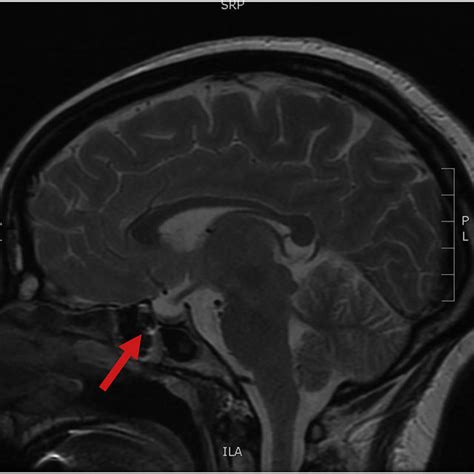 Brain MRI highlighting a partially empty sella (arrow) and flattened ...