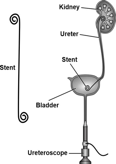 Cistoscopia e posizionamento dello stent ureterale | Adam Faliq