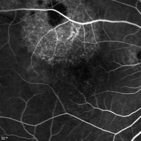 Circumscribed Choroidal Hemangioma - Retina Image Bank