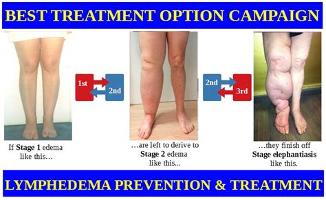 Elephantiasis Treatment