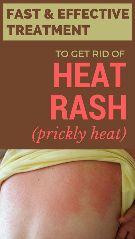 25+ bästa Prickly heat rash idéerna på Pinterest | Äppel cider vinäger ...