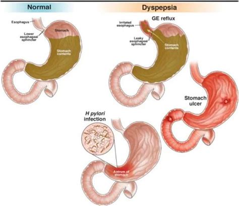 Gastroscopy Caboolture | Gastroesophageal Reflux Disease North Lakes ...