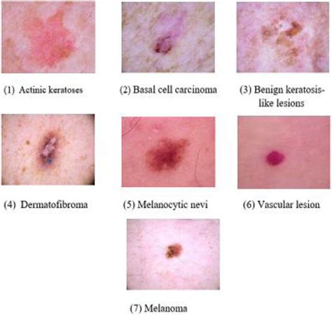 Skin Lesions Types