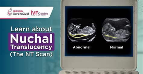 Learn About Nuchal Translucency (The NT Scan)