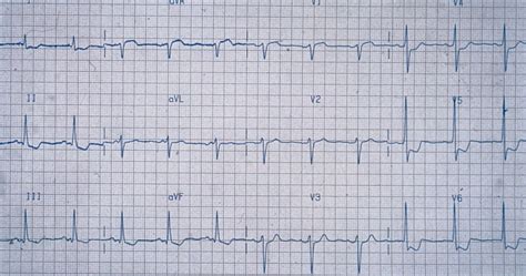 Ecg For Unstable Angina - unstable (preinfarction) angina pectoris and ...