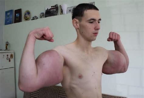 UPDATED: Russian Synthol Freak "Ruki Bazuki" Undergoes Biceps Surgery ...