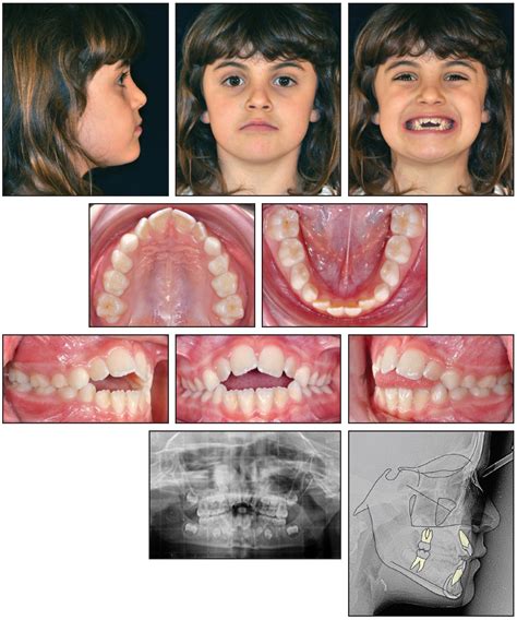 Treating Anterior Open Bite with Hybrid Aligner Therapy