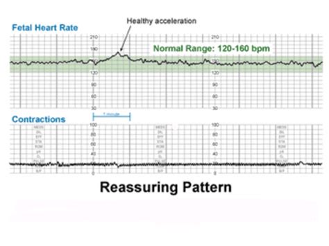 Contractions/Fetal Heart Rate Monitoring Flashcards | Quizlet