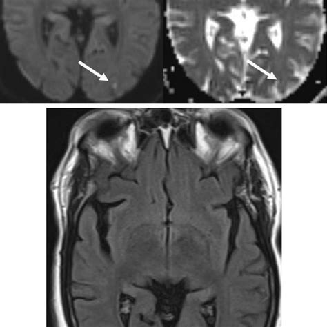 (a) MRI of the brain showing restricted diffusion on diffusion weighted ...