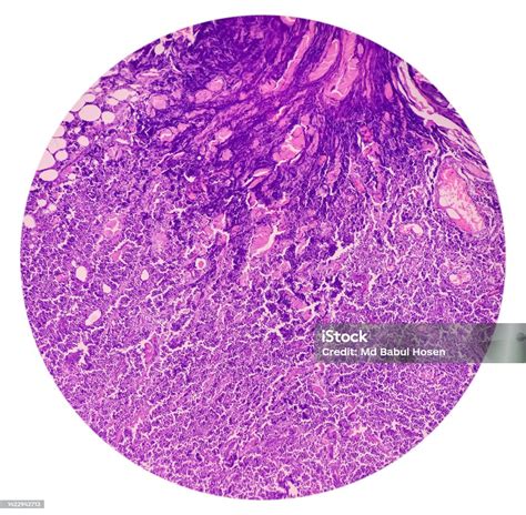 Supraclavicular Lymph Node Biopsy Microscopic Image Showing Benign ...